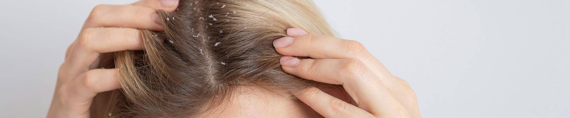 How to treat dandruff?