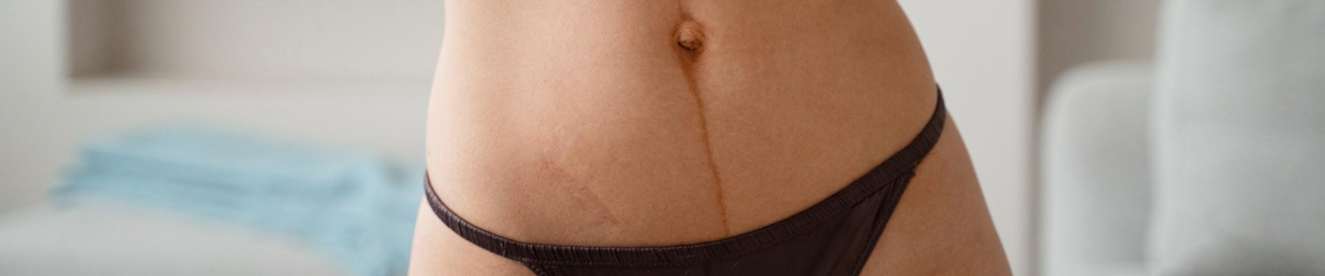 Keloid Scars