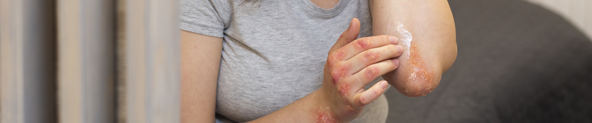 International Psoriasis Day