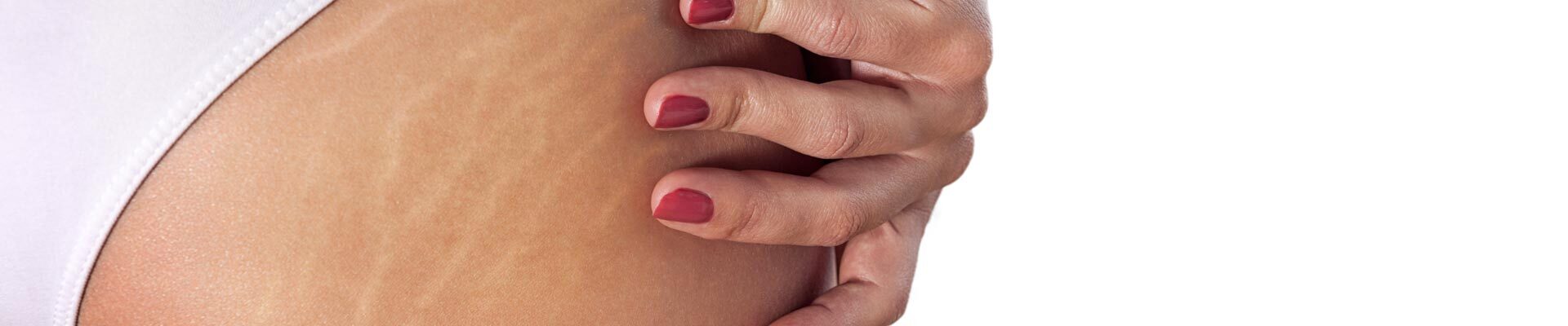 Stretch Marks on the Body