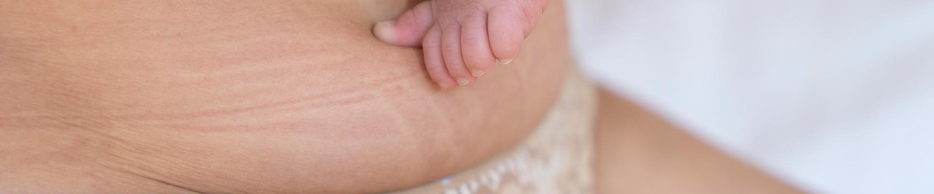 Stretch marks after pregnancy