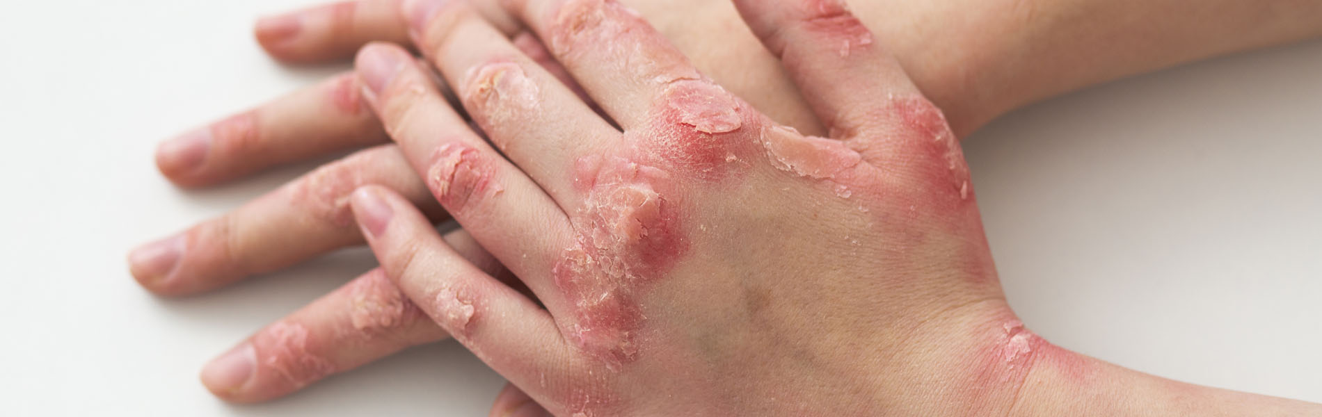 Immunobiological treatment of psoriasis
