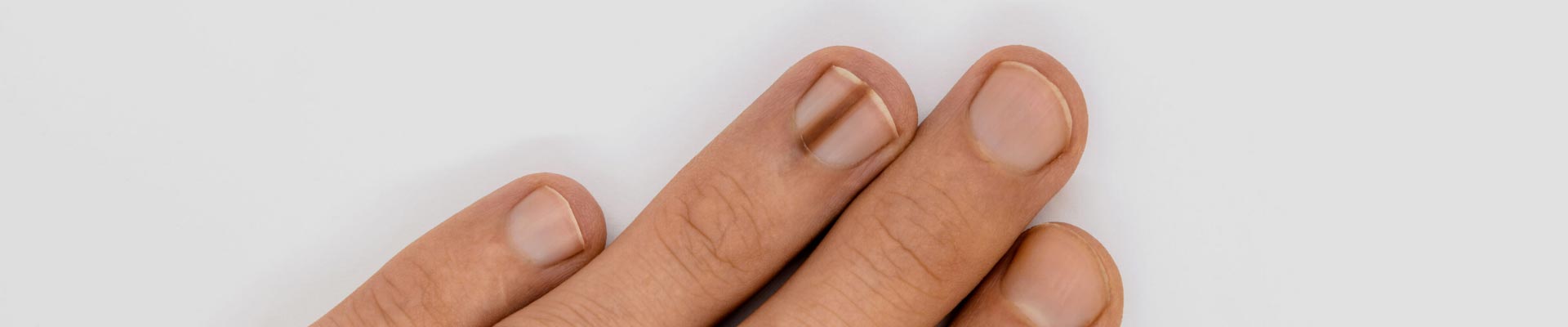 I'm 15 and South-East Asian Female, I have this brown line on my thumb. Is  this possibly a melanonychia or melanoma? - Quora