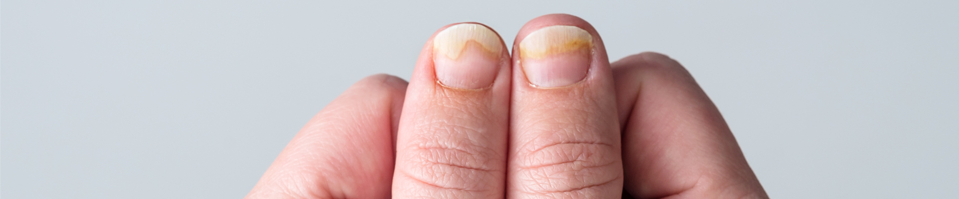 Brittle Nails | Causes and How to Care For Them